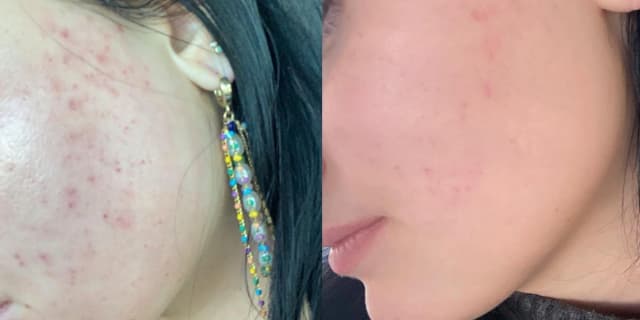 Microderm Facial