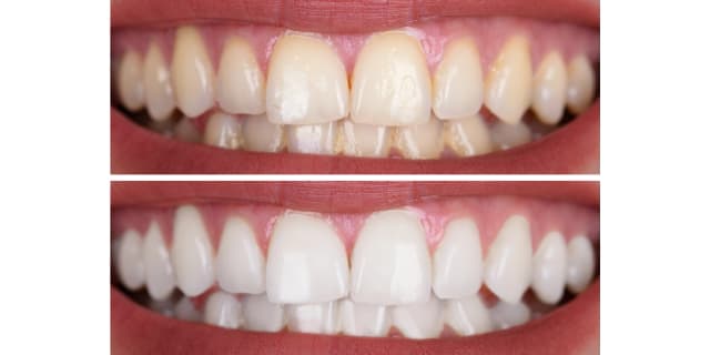 One 35-Minute Advanced Teeth Whitening Treatment and One Dermaplane Facial