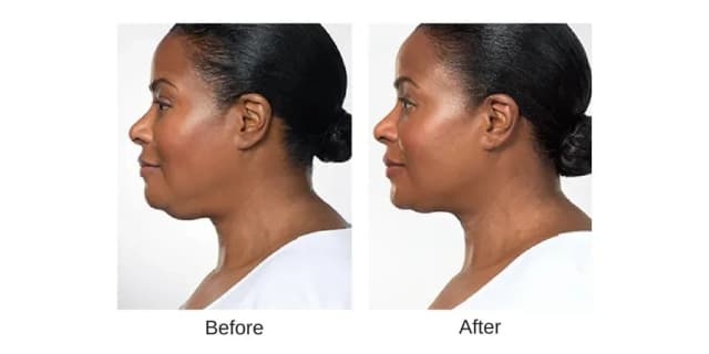 Two Vials of Kybella