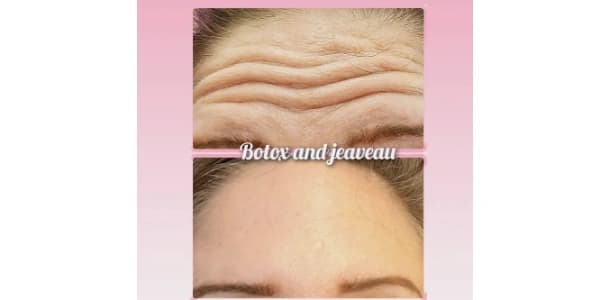 20 Units of Botox