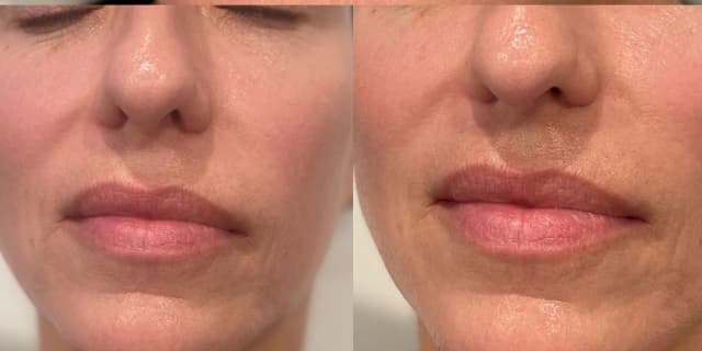 40 Units of Botox