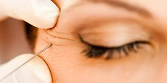 One Vial of Kybella