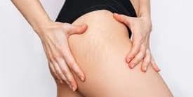 Three Laser Skin Resurfacing Sessions for Stretch Marks (Small Area)