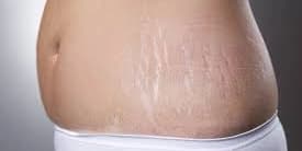 Three Laser Skin Resurfacing Sessions for Stretch Marks (Large Area)