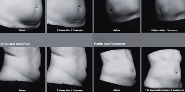 SculpSure Treatment