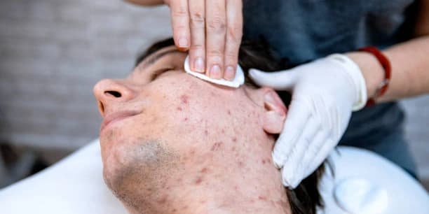 Two Acne Treatment Session cleanse, exfoliation, extractions, light peel, sulfur mask for acne and green light therapy