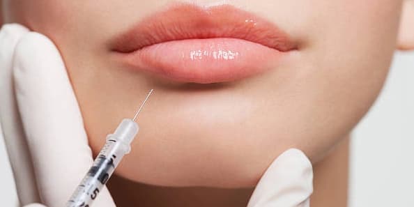 Botox Lip Flip