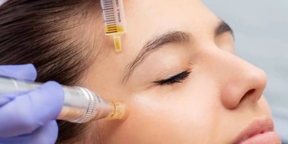 Two - Microneedling with MesoTheraphy