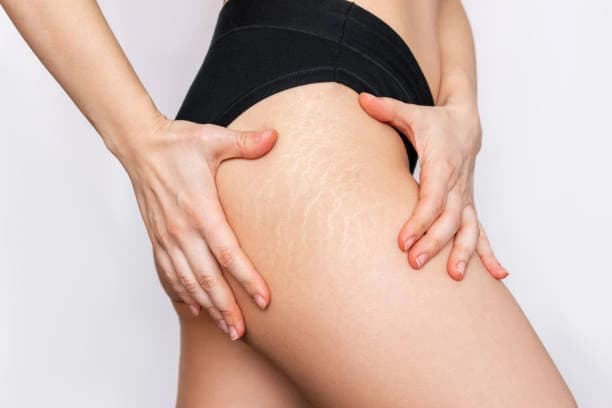 PRP Micro-needling for Scar Revision