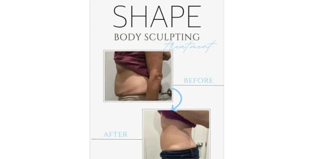 4 Non Surgical Permanent Fat Reduction Treatments