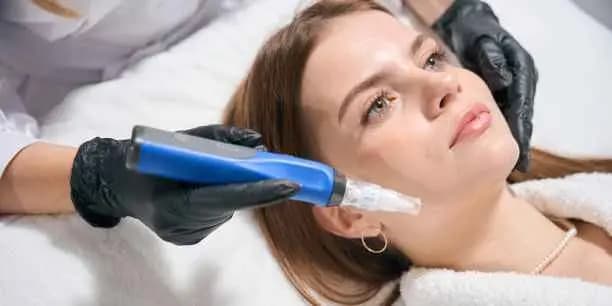 Vampire Facial