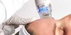 RF Micro-needling