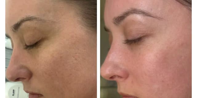Advanced Chemical Peel