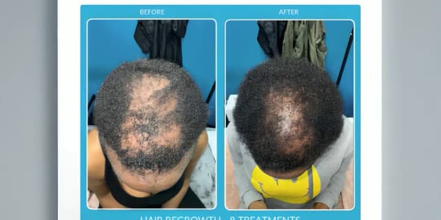 Hair Restoration