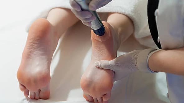 Callus Removal