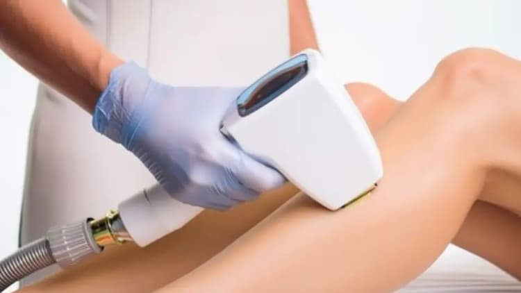 Vein Removal - Leg